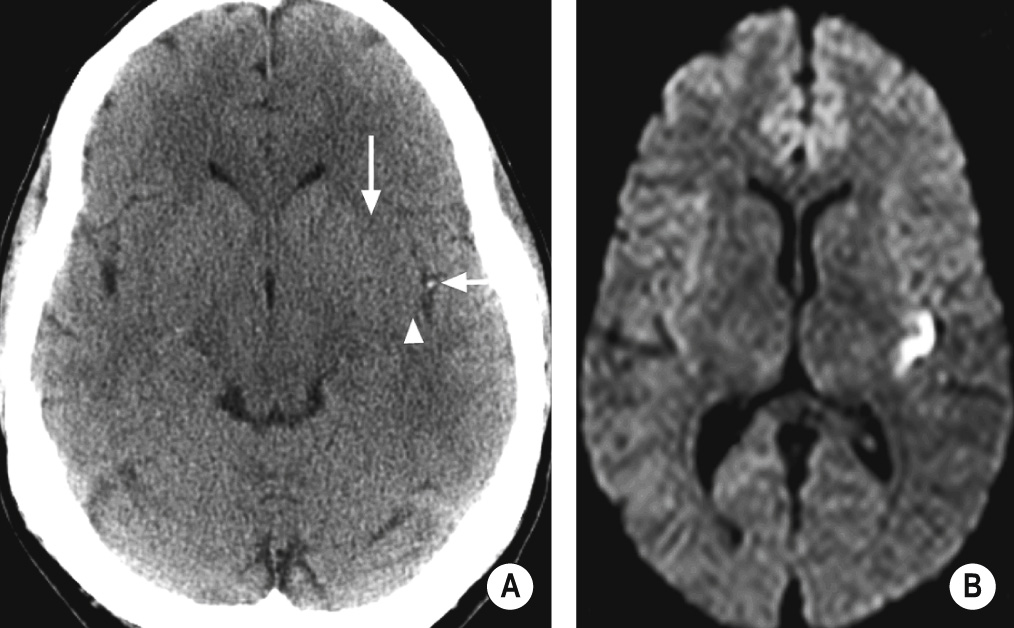 Sylvian ‘dot’ sign. (A) CT shows dense MCA branch due to occlusive acute thrombus (short arrow). There is very subtle loss of grey–white differentiation between the insular cortex and lateral border of putamen posteriorly (arrowhead), whereas more anteriorly it is preserved (long arrow). (B) DWI confirms a small acute cortical infarct adjacent to the thrombosed vessel. *