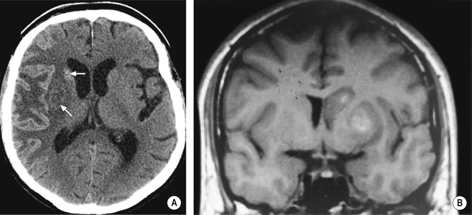 Haemorrhagic transformation. (A) NECT 2 weeks after a large right MCA territory infarct shows a gyriform pattern of haemorrhagic transformation in the right cerebral cortex. There is also haemorrhage in the basal ganglia (arrows). (B) Coronal T1WI shows swelling and signal alteration of the caudate and lentiform nuclei. Sparing of the cortex is due to adequate leptomeningeal collateral circulation. The central T1–high SI area within the infarct indicates haemorrhagic transformation. *
