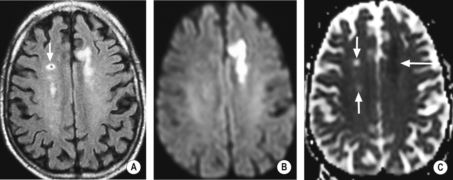 New and old infarcts on DWI. (A) FLAIR shows high signal ischaemic change of indeterminate age in both frontal lobes. There is a small mature lacunar infarct on the right with a low SI central cavity (arrow). (B) DWI shows an acute high SI lesion on the left. (C) The ADC map confirms the left-sided lesion is acute (dark indicates low ADC ▸ long arrow). The infarcts on the right are bright, indicating increased ADC and therefore older lesions (short arrows). *