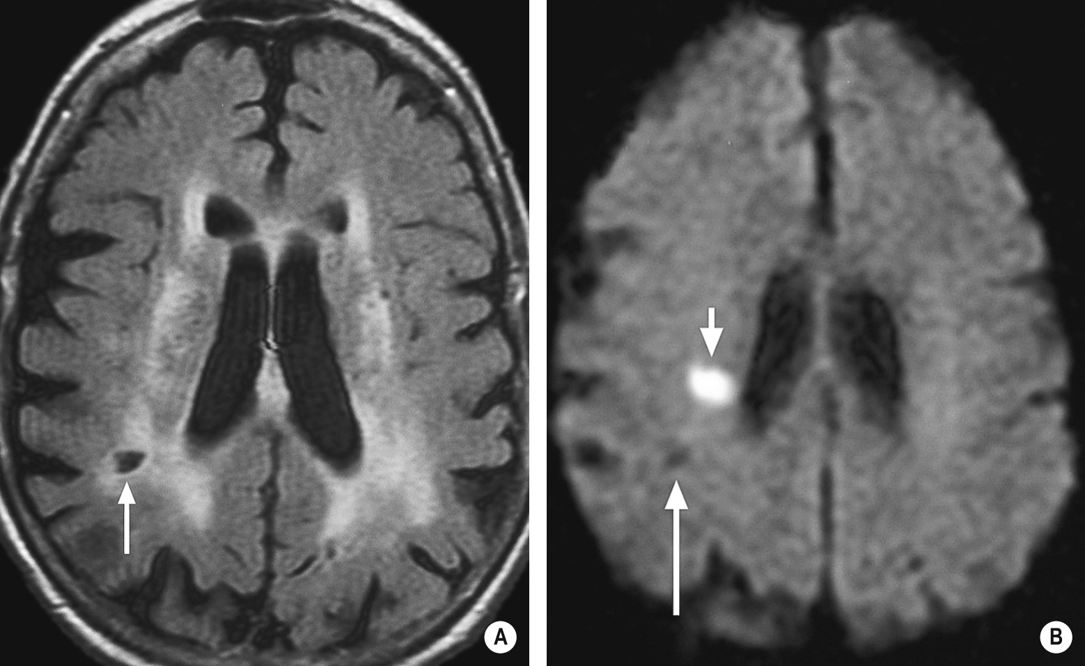 Small vessel disease. (A). Axial FLAIR of a patient shows diffuse high signal indicating small vessel ischaemic change in deep and periventricular cerebral white matter. There is a mature lacunar infarct in the right parietal lobe (arrow). (B). Axial DWI shows an acute infarct as high signal (short arrow) and the mature lacuna as low signal (long arrow). Only DWI can differentiate the acute infarct from the surrounding signal abnormality. *