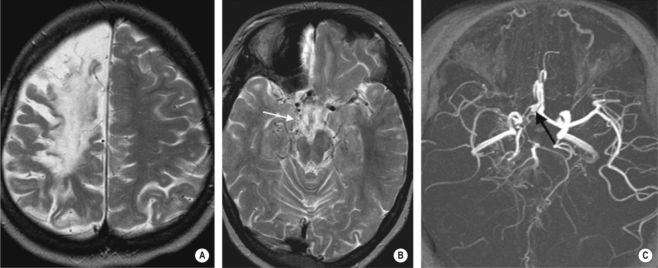 Sickle cell disease and Moyamoya syndrome. (A) Child with extensive frontal, deep and posterior watershed infarction. (B) Extensive perimesencephalic ‘Moyamoya’ collaterals (arrow) and attenuated right middle cerebral artery (MCA) flow voids. (C) Compressed maximum intensity projection image shows narrowed terminal internal carotid artery (ICA), reduced filling of right MCA and A1 segment of the anterior cerebral artery. There is an aneurysm at the A1/anterior communicating artery (ACOM) junction (arrow). *