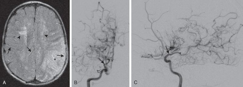 Figure 36.1, Moyamoya disease in a 2-year-old child presenting with new-onset right-sided hemiplegia.