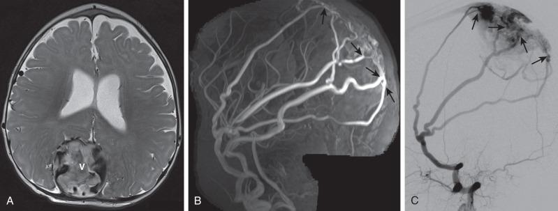 Figure 36.2, Dural arteriovenous fistula in a 5-month-old girl presenting with vomiting, lethargy, macrocephaly, and distended pulsating scalp veins.