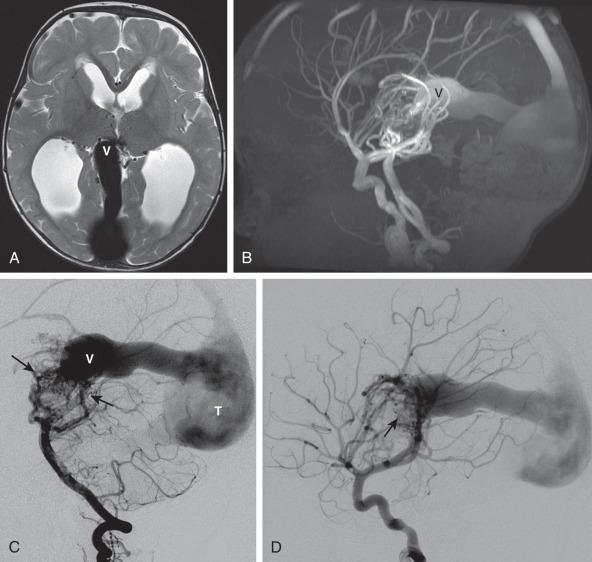 Figure 36.3, Vein of Galen malformation in a 12-month-old child presenting with macrocephaly and developmental delay.