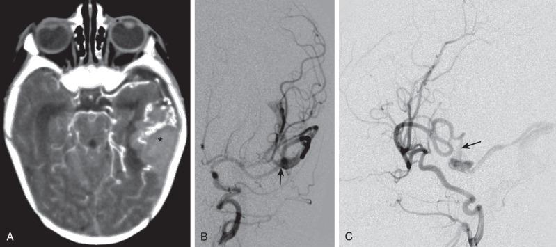 e-Figure 36.4, Pial arteriovenous fistula and left temporal hemorrhage in an 18-day-old child presenting with irritability, poor feeding, and vomiting.