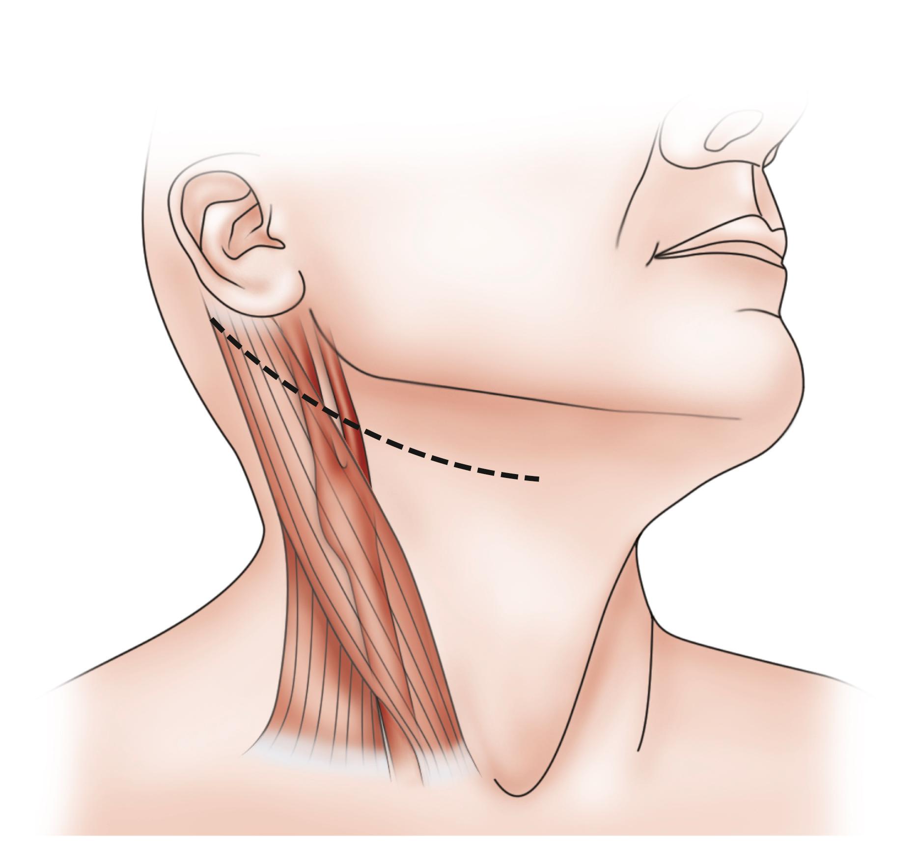 Figure 57.2, Oblique incision for carotid endarterectomy.