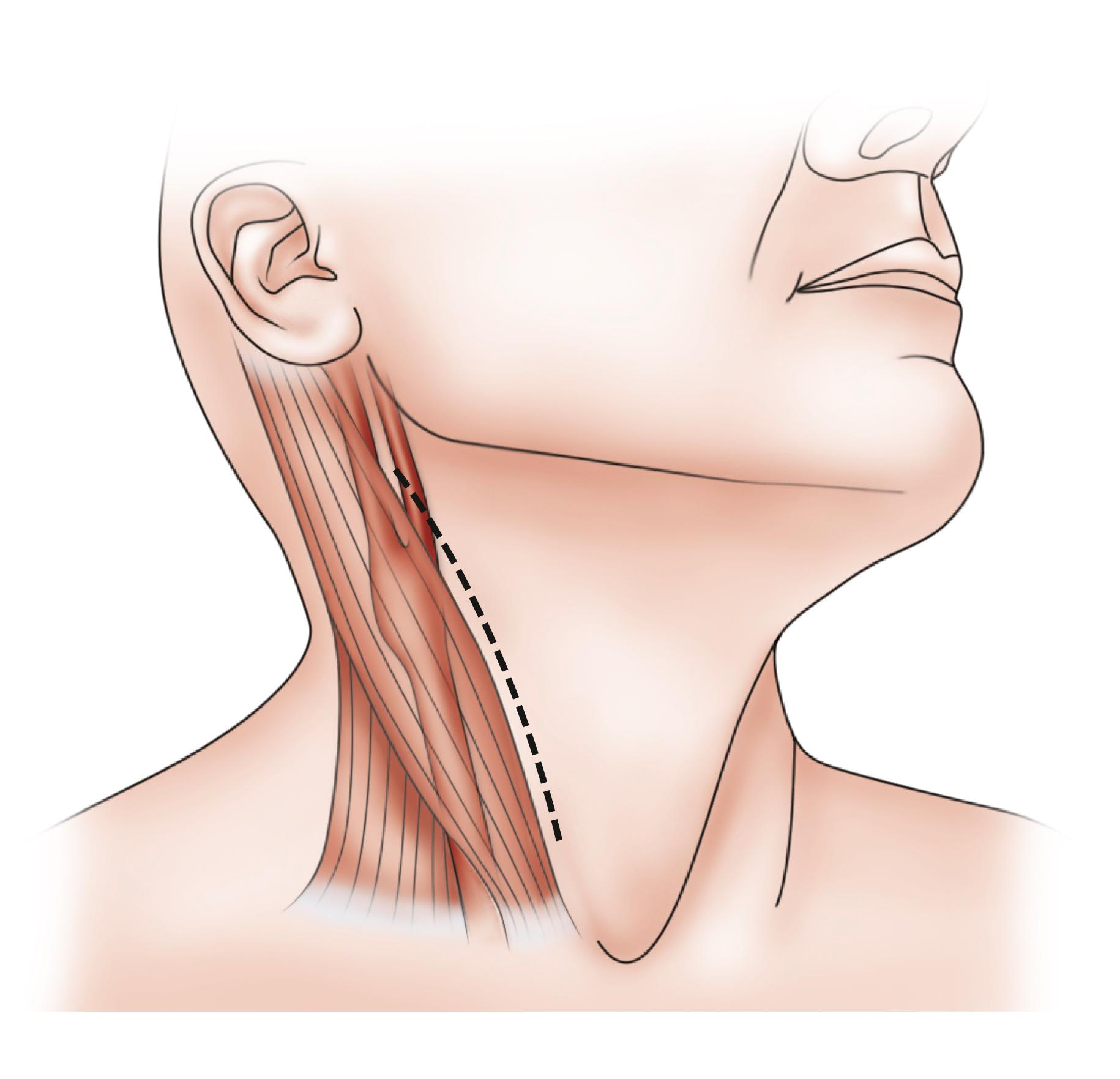 Figure 57.1, Incision for carotid endarterectomy.