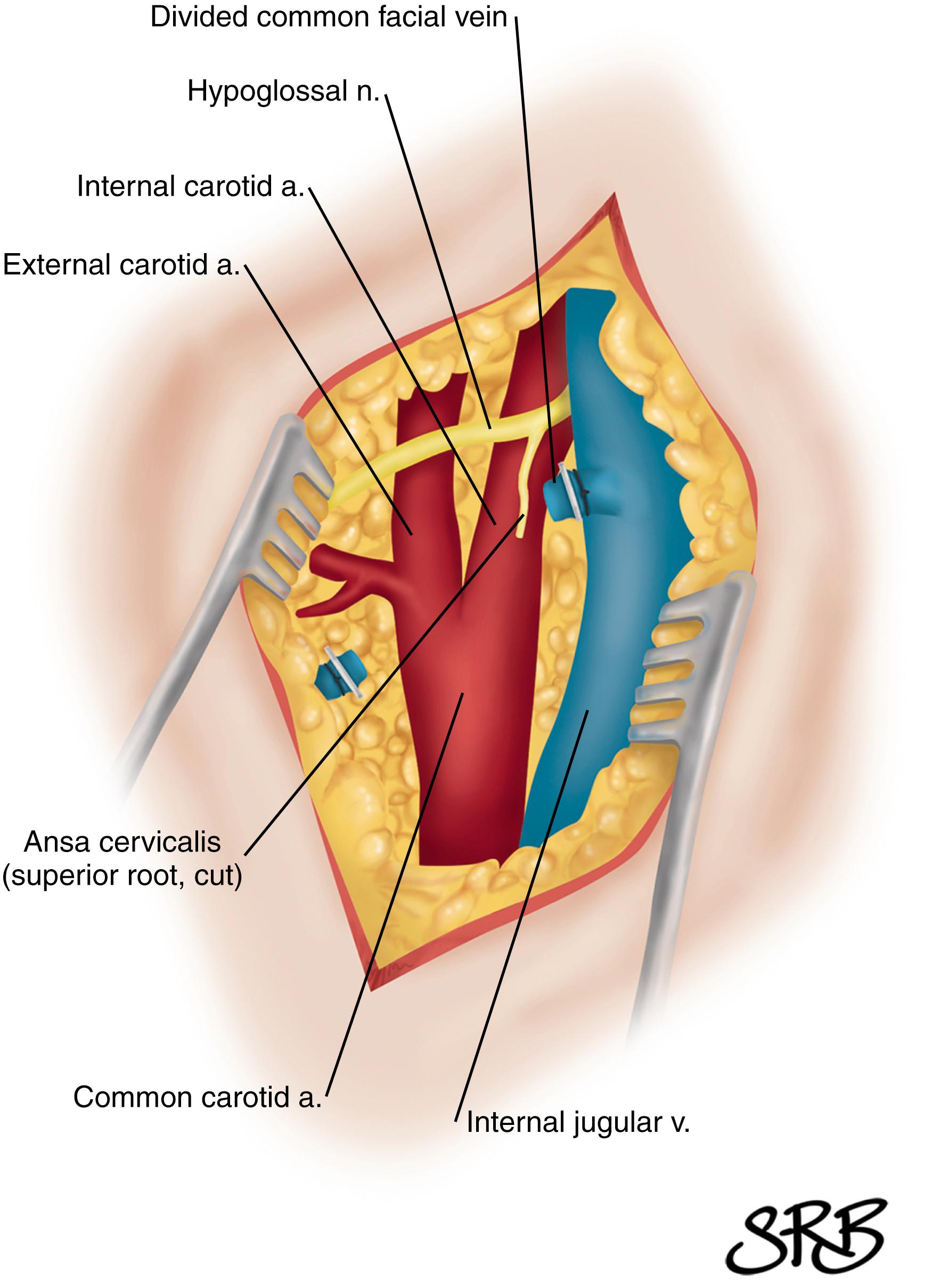 Figure 57.3, Traditional carotid exposure with division of facial vein and ansa cervicalis. Left CEA approach.