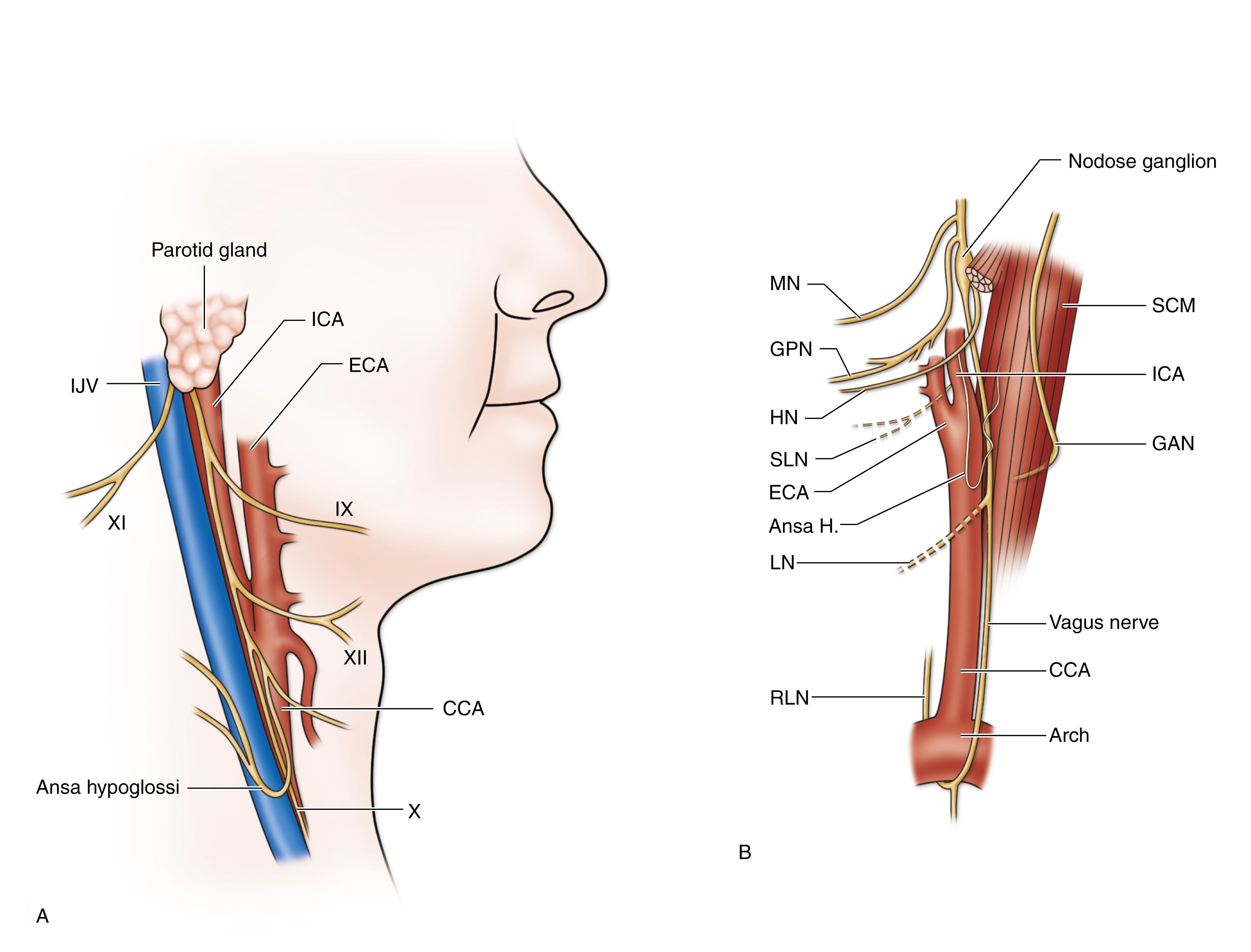 Figure 57.4, ( A ) Illustration showing relation of cranial nerve to carotid bifurcation. IJV , internal jugular vein; ICA , internal carotid artery; ECA , external carotid artery; XI , accessory spinal nerve; IX , glossopharyngeal nerve; XII , hypoglossal nerve; CCA , common carotid artery; X , vagus nerve. ( B ) Illustration of various cranial/cervical nerves and their anomalies. MN , marginal mandibular nerve; GPN , glossopharyngeal nerve; HN , hypoglossal nerve; SLN , superior laryngeal nerve; ECA , external carotid artery; Ansa H , ansa hypoglossal nerve; LN , nonrecurrent laryngeal nerve (anomaly); RLN , recurrent laryngeal nerve; SCM , sternocleidomastoid muscle; ICA , internal carotid artery; GAN , greater auricular nerve; CCA , common carotid artery.