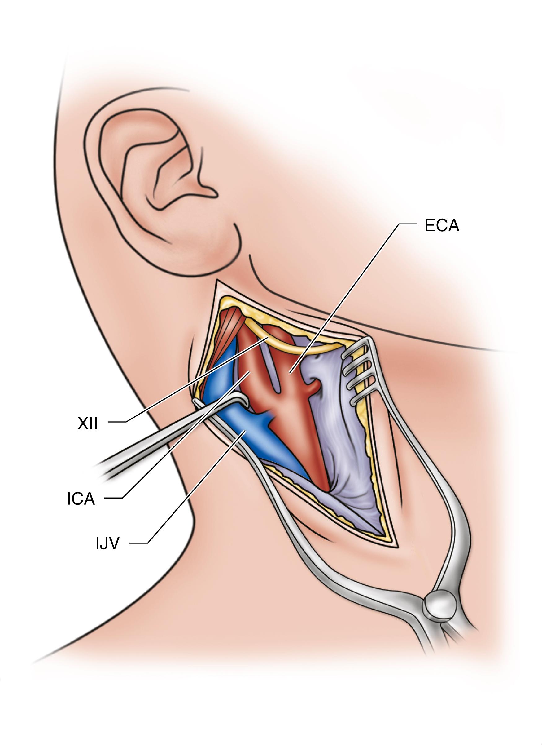 Figure 57.5, Exposure of distal CCA, ICA, and ECA. XII , hypoglossal nerve; ECA , external carotid artery; ICA , internal carotid artery; IJV , internal jugular vein.