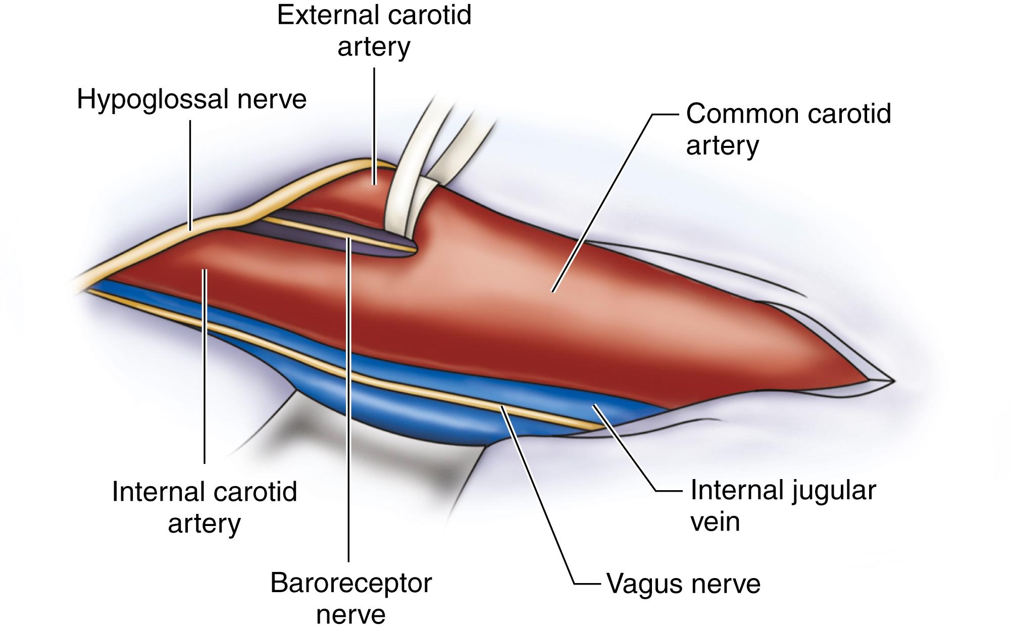 Figure 57.6, Isolation of carotid artery bifurcation during carotid endarterectomy.