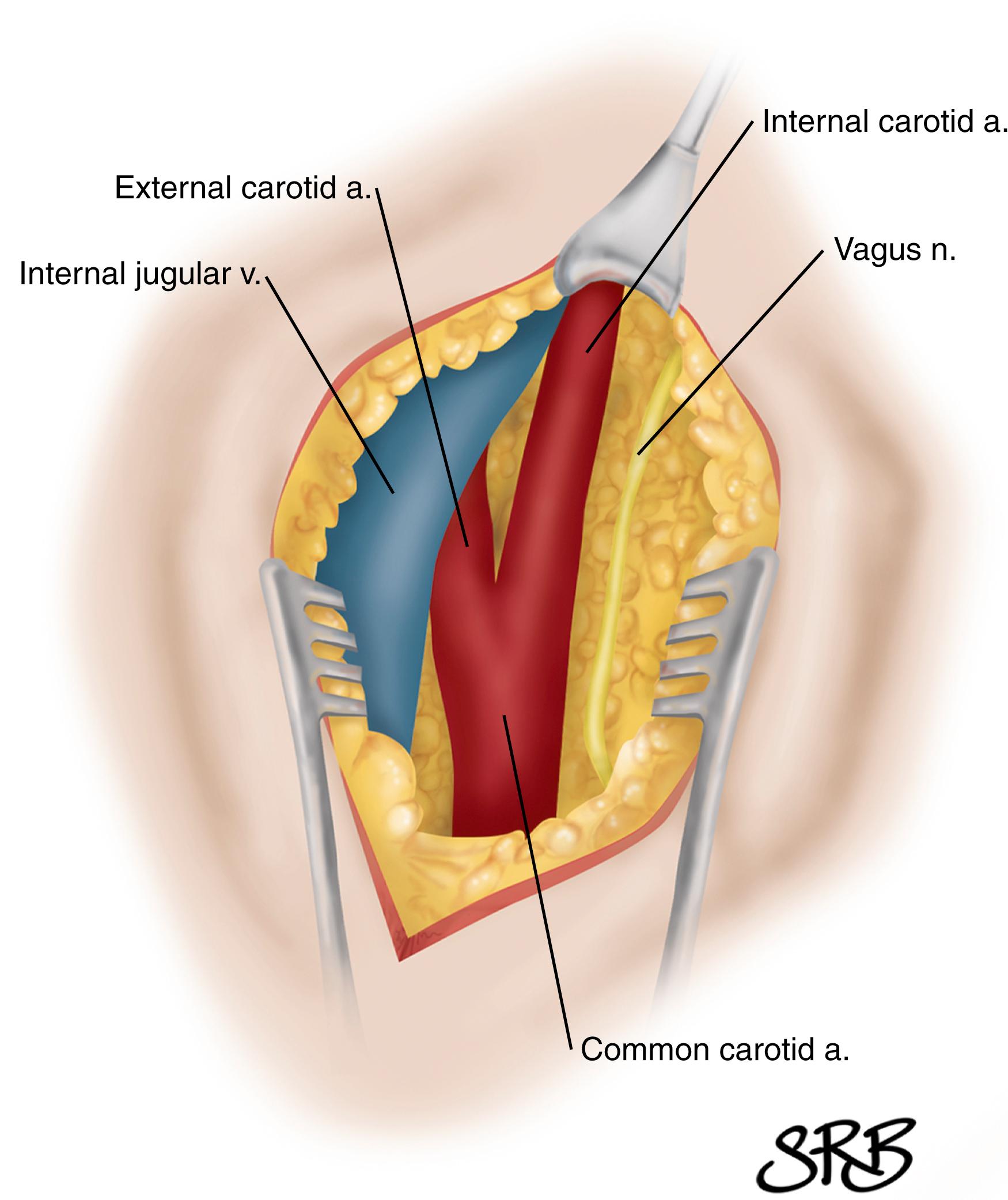 Figure 57.7, Retrojugular approach to carotid artery with medial rotation of internal jugular vein to expose internal carotid artery. Left CEA approach.