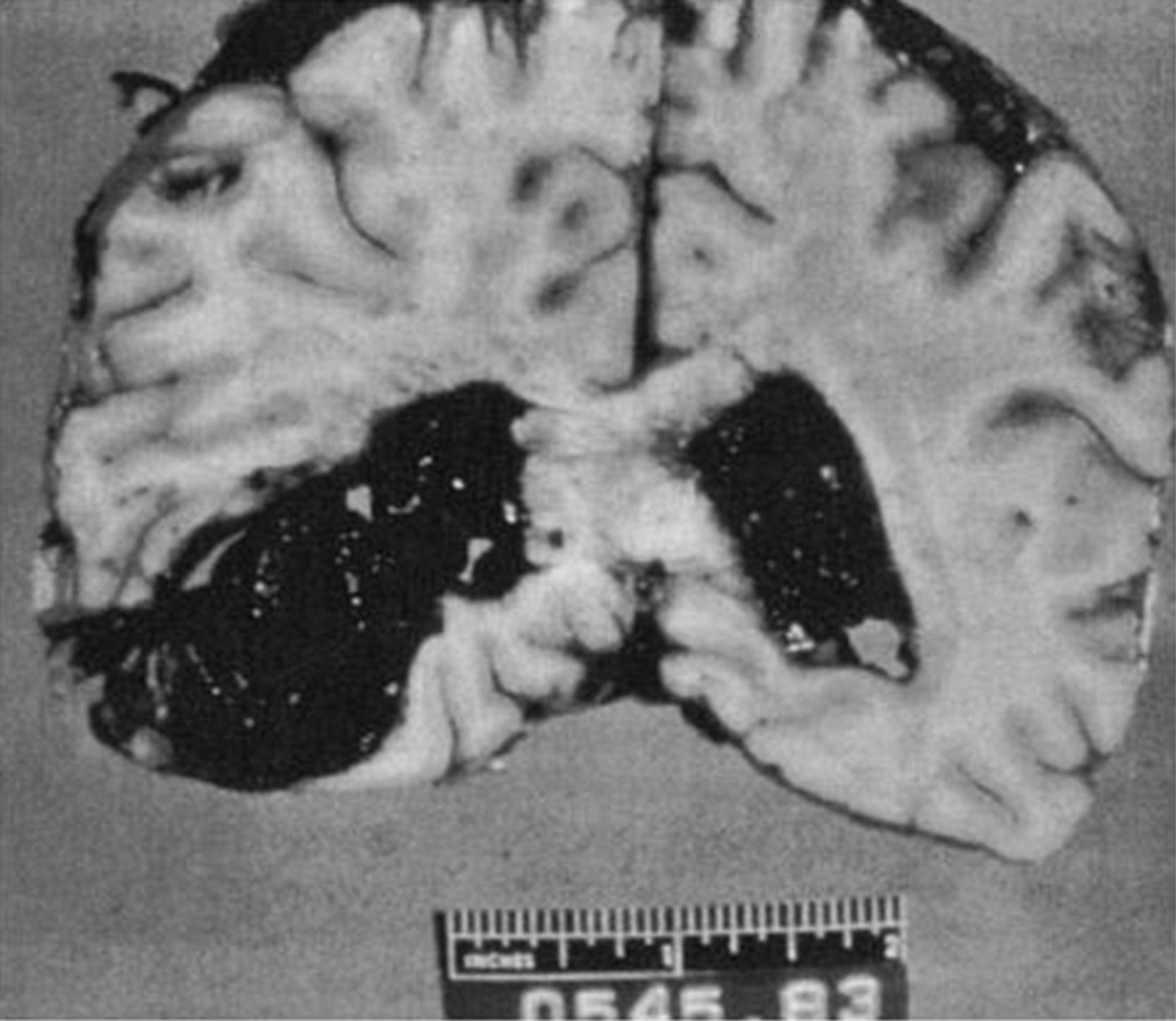 Figure 13.1, Hypertensive hemorrhage with eclampsia.