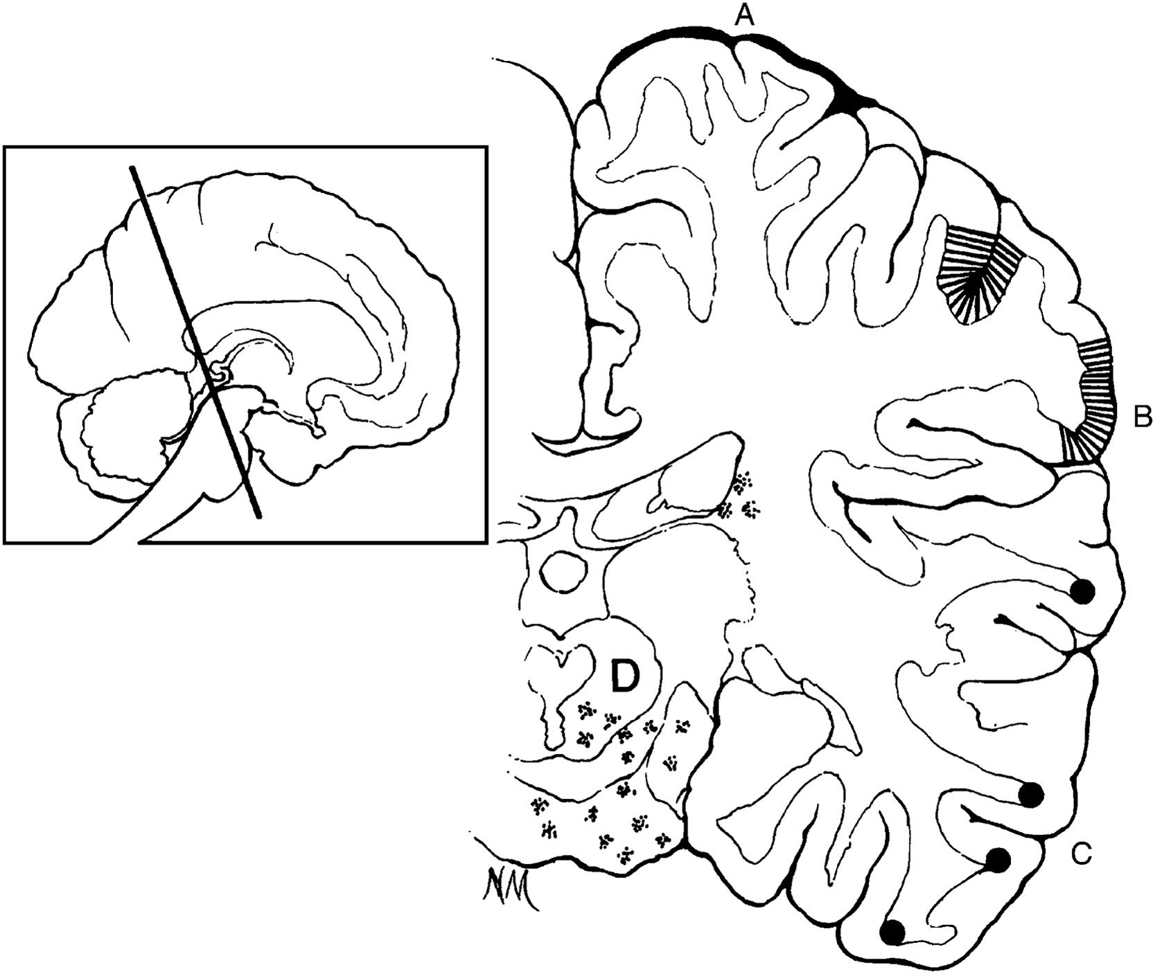 Figure 13.2, Composite illustration showing location of cerebral hemorrhages and petechiae in women with eclampsia: (A) pia-arachnoid hemorrhage; (B) cortical petechiae; (C) subcortical petechiae; and (D) focal softenings or petechiae in midbrain or white matter.