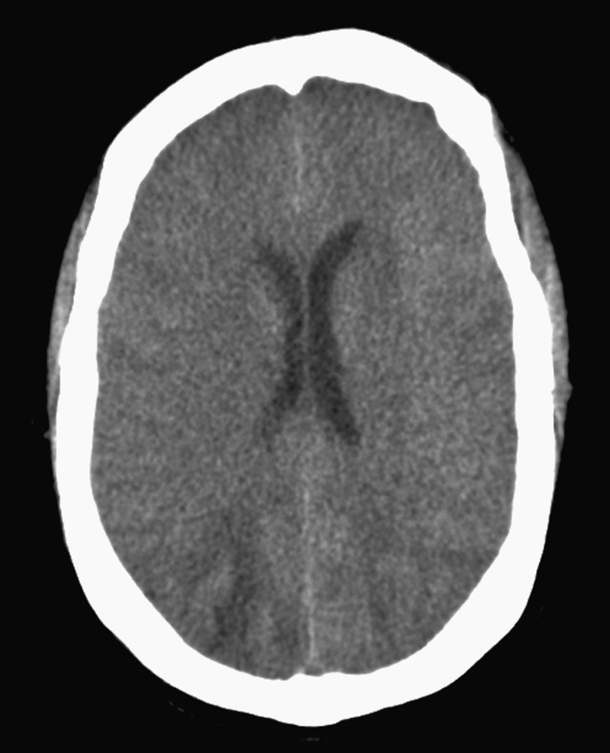 Figure 13.3, Cranial CT of a woman with eclampsia. Radiographic low-density areas ( arrow ) are seen in the right occipital lobe.