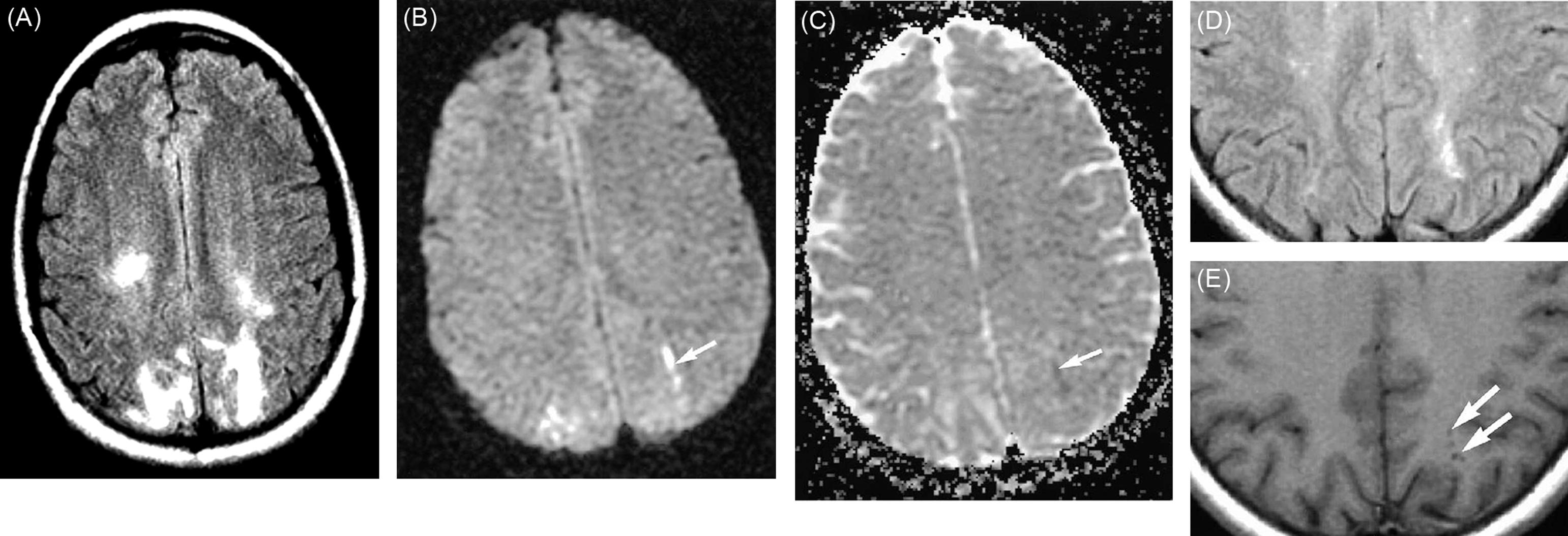 Figure 13.4, Classic MRI pattern of vasogenic edema in eclampsia with associated subcortical infarction. (A) T2 hyperintensity on FLAIR images indicates parietooccipital distribution of vasogenic edema. (B) Within this volume is a smaller area of hyperintensity on DWI ( arrow ). (C) That this signal is due to restricted diffusion is confirmed by hypointensity on the ADC map ( arrow ). (D) These findings suggesting areas of subcortical infarction are supported by follow-up studies obtained 6 weeks later in which T2 hyperintensity on FLAIR image and (E) corresponding low signal intensity on T1-weighted image ( arrows ) indicated evolution to gliosis.