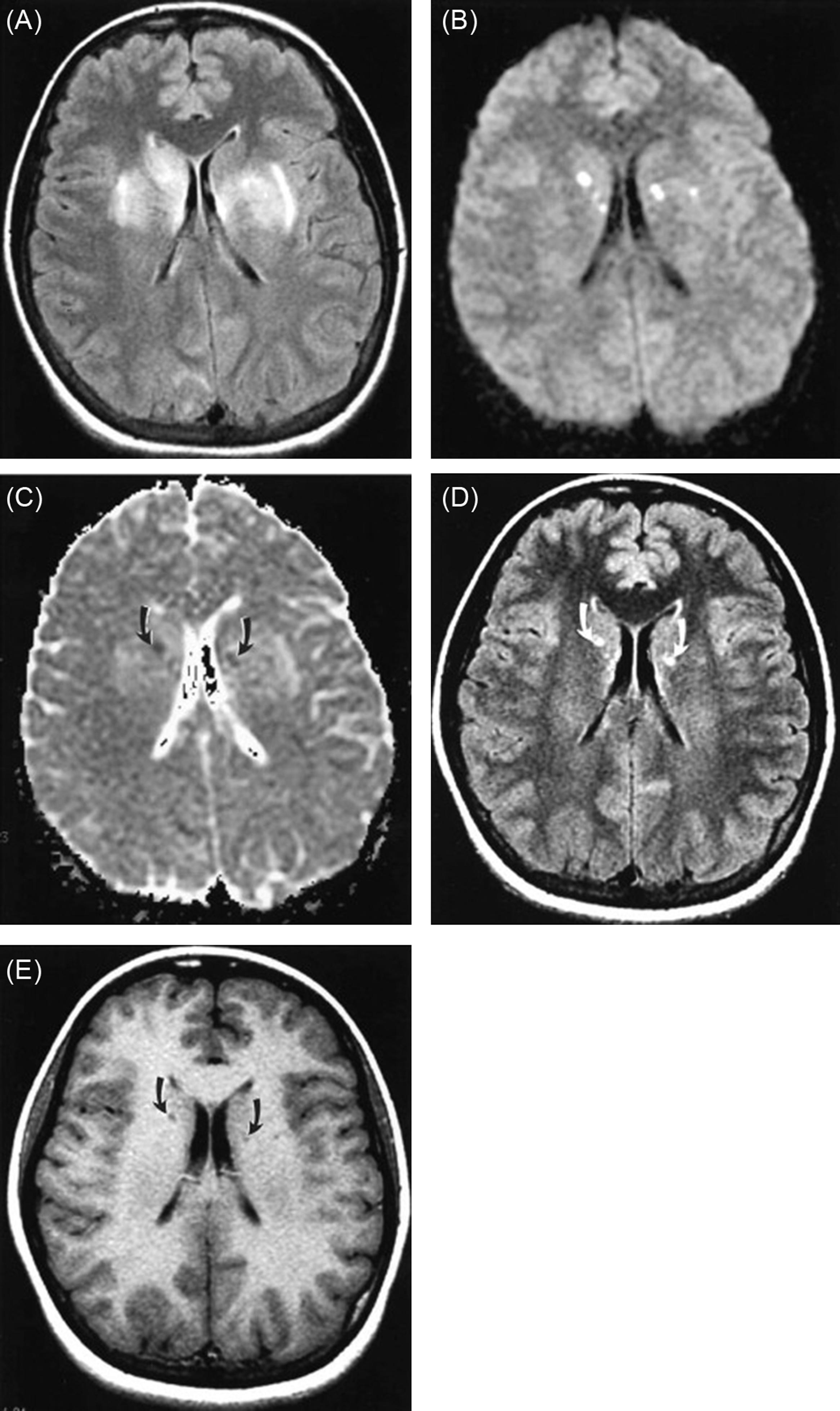 Figure 13.5, MRI evidence of hypertensive encephalopathy and lacunar infarctions in eclampsia. This case demonstrates the occasional atypical distribution of signal abnormalities away from the parietooccipital region. (A) Note on T2-weighted FLAIR image that the predominant changes occur in the basal ganglia regions bilaterally. (B) Small foci of cytotoxic edema are indicated by the marked hyperintensity on DWIs. (C) Corresponding reduced ADC ( arrows ). (D) These small, presumed lacunar infarctions show a typical evolution on repeat examination 6 weeks after the initial events as T2 hyperintensity on FLAIR ( arrows ) and (E) low signal intensity on T1-weighted image ( arrows ) in regions corresponding to DWI evidence of infarct (see B and C) on the initial studies. Hypertensive encephalopathy is neither necessarily posterior nor reversible.