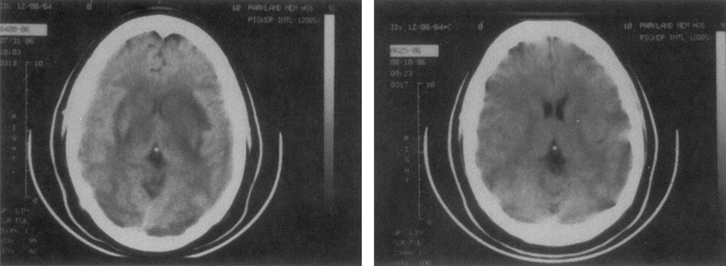 Figure 13.6, Computed tomographs in a woman with cerebral edema following acutely exacerbated severe hypertension. The radiograph on the left shows slit-like effaced ventricles as well as sharply demarcated gray–white interface, both indicating parenchymal swelling. The radiograph on the right taken 10 days later shows diminished edema manifest by larger ventricles and loss of gray–white interface demarcation.