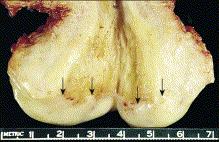 Figure 8.1, Normal cervix. The specimen has been opened to show the rough appearance of the cervical canal in contrast to the smoothness of the ectocervix. The squamocolumnar junction (arrows) is clearly visible.