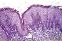 Figure 8.11, Squamous hyperplasia. The epithelium is acanthotic with hyperkeratosis and parakeratosis.