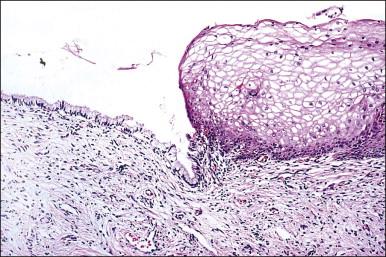 Figure 8.16, Squamocolumnar junction. There is an abrupt transition from squamous to columnar epithelium.