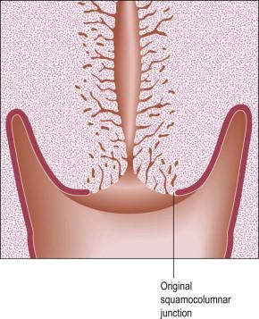 Figure 8.20, The process of eversion. On completion, endocervical columnar tissue lies on the vaginal surface of the cervix and is exposed to the vaginal environment.