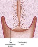 Figure 8.21, Postadolescent cervix. The acidity of the vaginal environment is one of the factors that encourage squamous metaplastic change, replacing the exposed columnar epithelium with squamous epithelium.