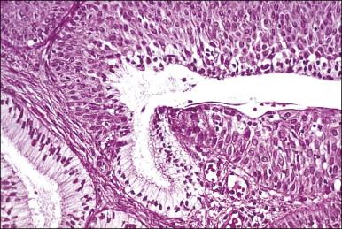 Figure 8.26, Immature squamous metaplasia. The lack of differentiation and maturation can cause confusion with intraepithelial neoplasia.