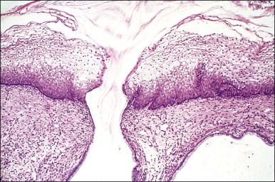 Figure 8.27, Mature squamous metaplasia. The mature metaplastic squamous epithelium here overlies gland crypts, lined by columnar epithelium. Mucin is being discharged from a gland opening.