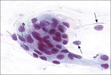 Figure 8.4, Parabasal squamous cells in a cervical smear. Cells with large nuclei with evenly distributed chromatin. Free nuclei (arrows) are present.