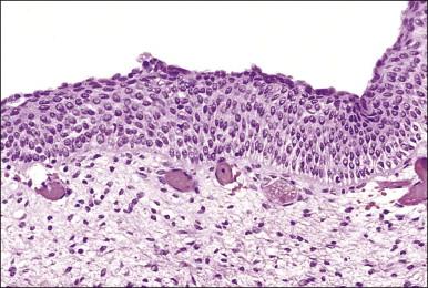 Figure 8.8, Atrophic squamous epithelium in a 6-year-old girl.