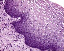 Figure 8.10, Basal cell hyperplasia. The parabasal and basal zones are markedly expanded in an epithelium that is also somewhat thickened. The picket fence appearance of the basal layer is lost.