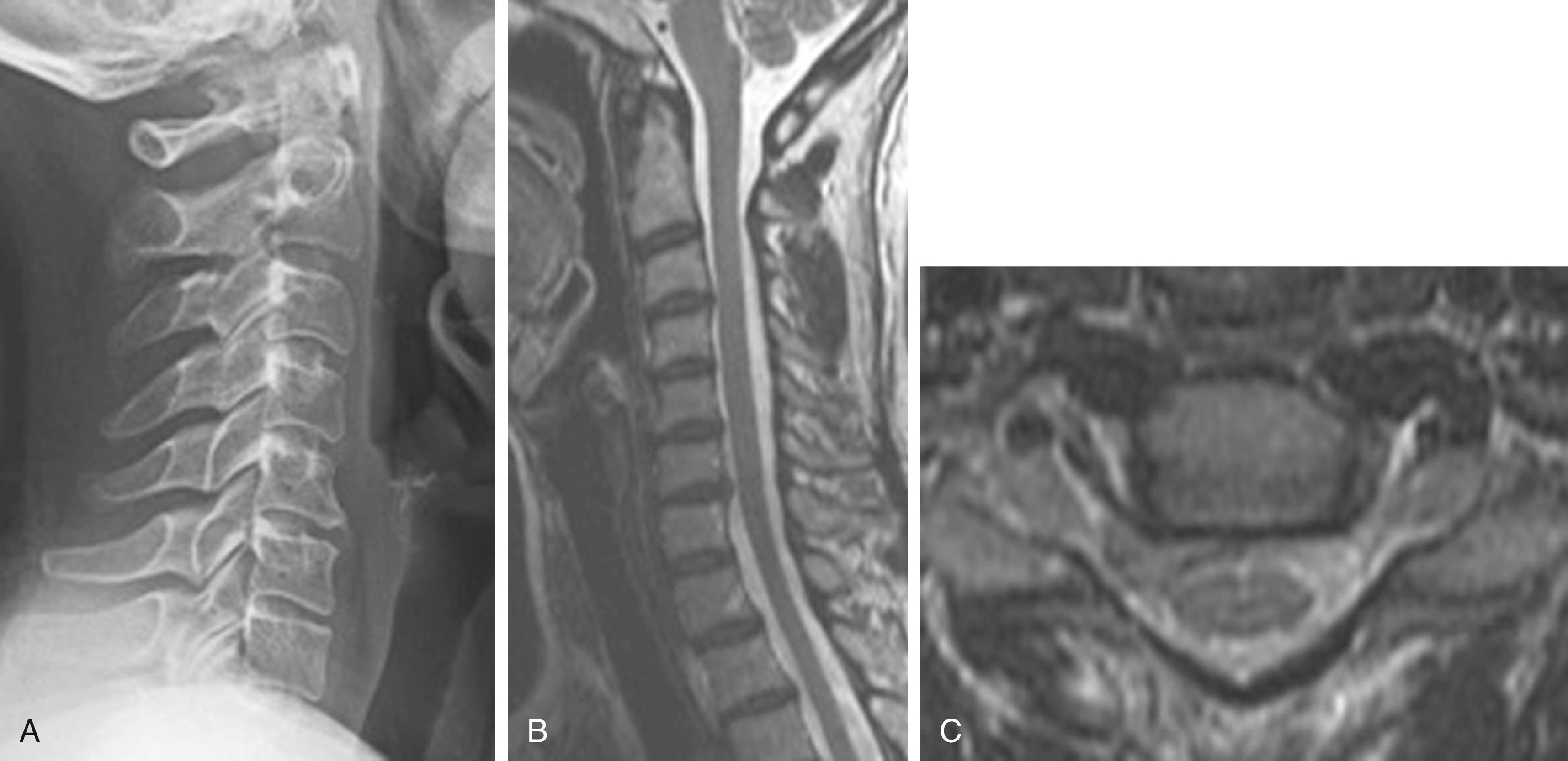 Fig. 136.1, A, Lateral radiograph of the cervical spine fails to demonstrate significant signs of arthritis or spondylolisthesis. B, Sagittal T2 magnetic resonance imaging (MRI) demonstrates a 2.5-mm central bulge at C6‒C7. C, Axial T2 MRI demonstrates a large right-sided disc herniation causing significant neural compression of the C7 exiting nerve root.