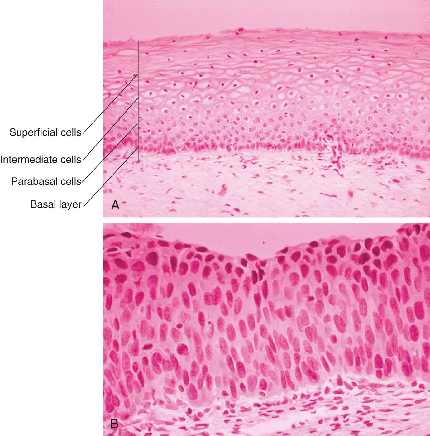 FIGURE 38-2, Histologic appearance of normal cervical squamous epithelium (A) and high-grade squamous intraepithelial lesion (HSIL) (B) of the cervix. In the normal epithelium, note the orderly maturation from the basal layer to the parabasal cells, glycogenated intermediate cells, and flattened superficial cells. In the HSIL, the entire thickness of the epithelium is replaced by immature cells that are variable in size and shape and have irregular nuclei. Mitotic figures are seen in the lower two-thirds of the epithelium.