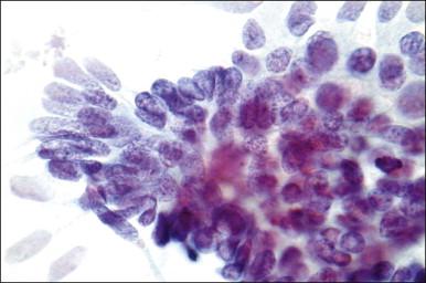 Figure 12.11, AIS, endocervical type (Pap smear). A crowded sheet with ragged edges. Hyperchromatic elongated nuclei show palisading and feathering at the edges of the sheet.