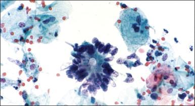 Figure 12.12, AIS, endocervical type (Pap smear). A rosette displays a central lumen and a ragged periphery.