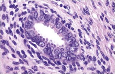 Figure 12.13, Tuboendometrioid metaplasia.