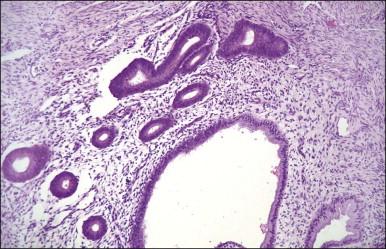 Figure 12.14, Superficial cervical endometriosis.