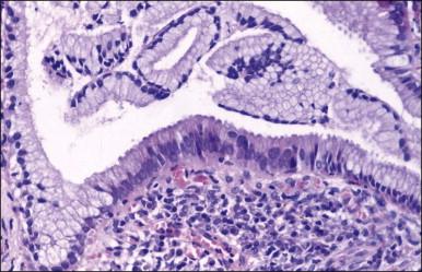 Figure 12.15, Endocervical gland showing inflammatory changes.