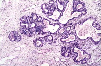 Figure 12.2, AIS. Clusters of glands involved by AIS