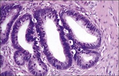 Figure 12.3, AIS endocervical type with numerous mitoses and apoptosis.