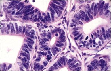 Figure 12.4, AIS. Stratification with elongated, cigar-shaped, hyperchromatic nuclei.