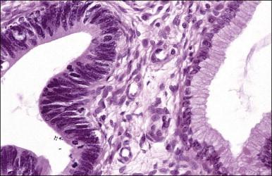 Figure 12.5, AIS compared with normal endocervical gland.