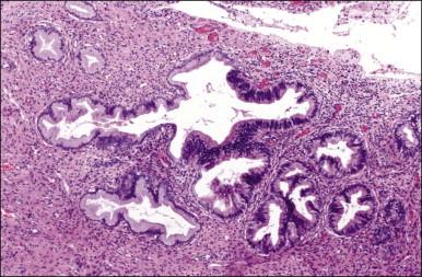 Figure 12.6, AIS. Sharp demarcation from closely uninvolved glands and from the uninvolved epithelium of the same gland.