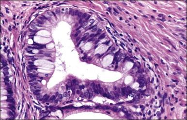 Figure 12.7, AIS, intestinal type with numerous goblet cells.