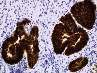 Figure 12.9, AIS. Overexpression of p16 INK4A .