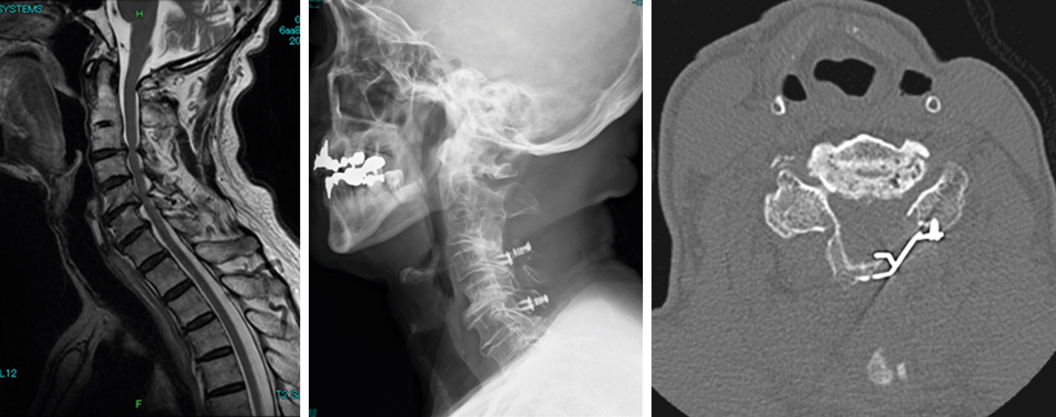 Fig. 106.1, A patient with cervical spondylotic myelopathy who underwent laminoplasty. Axial computed tomography image of the expanded spinal canal space created by inserting a laminar plate.