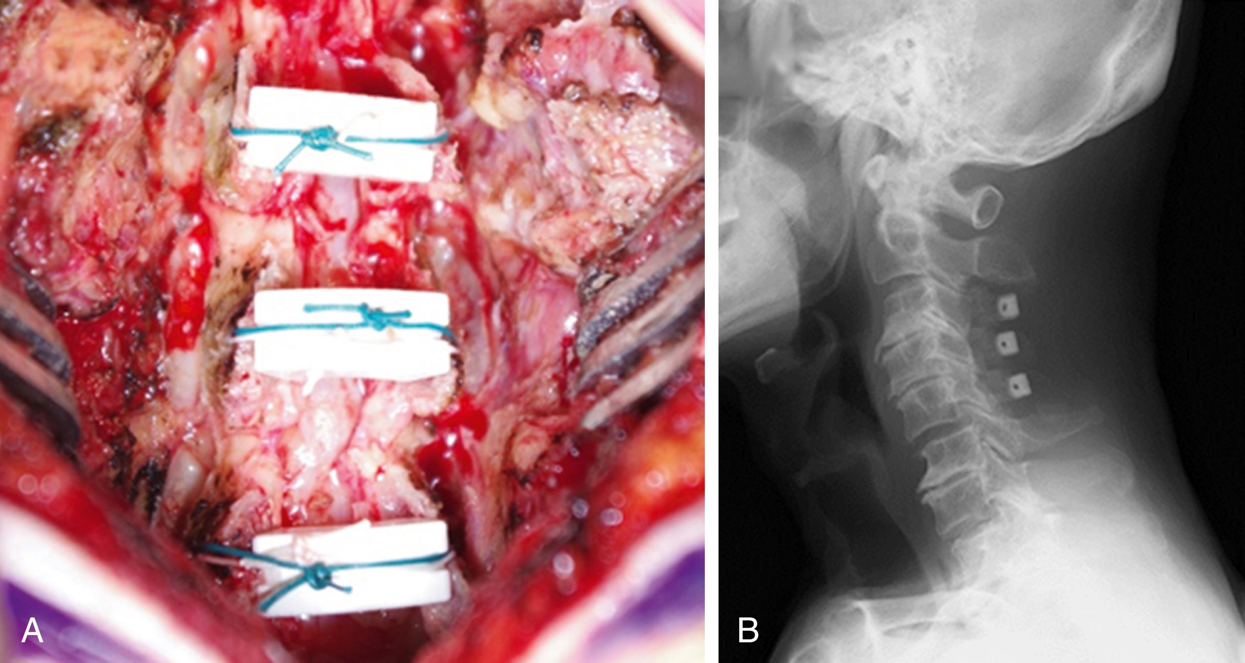 Fig. 106.2, Representative images of double-door laminoplasty during surgery ( A ) and postoperatively ( B ).