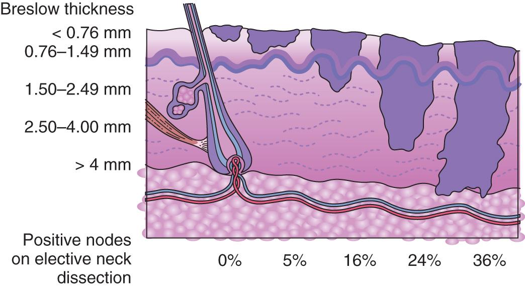 Figure 11.13, The risk of occult nodal metastasis in a cutaneous melanoma relative to the depth of the primary lesion.