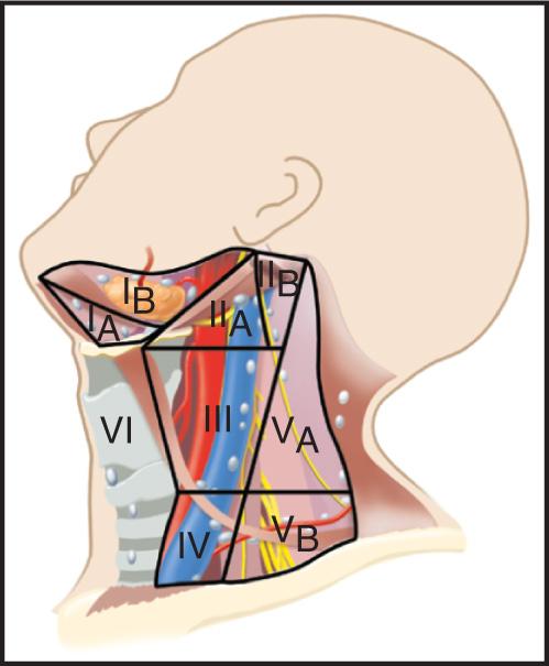 Figure 11.6, The American Academy of Otolaryngology-Head and Neck Surgery modification of the system of assigning levels for cervical lymph nodes.